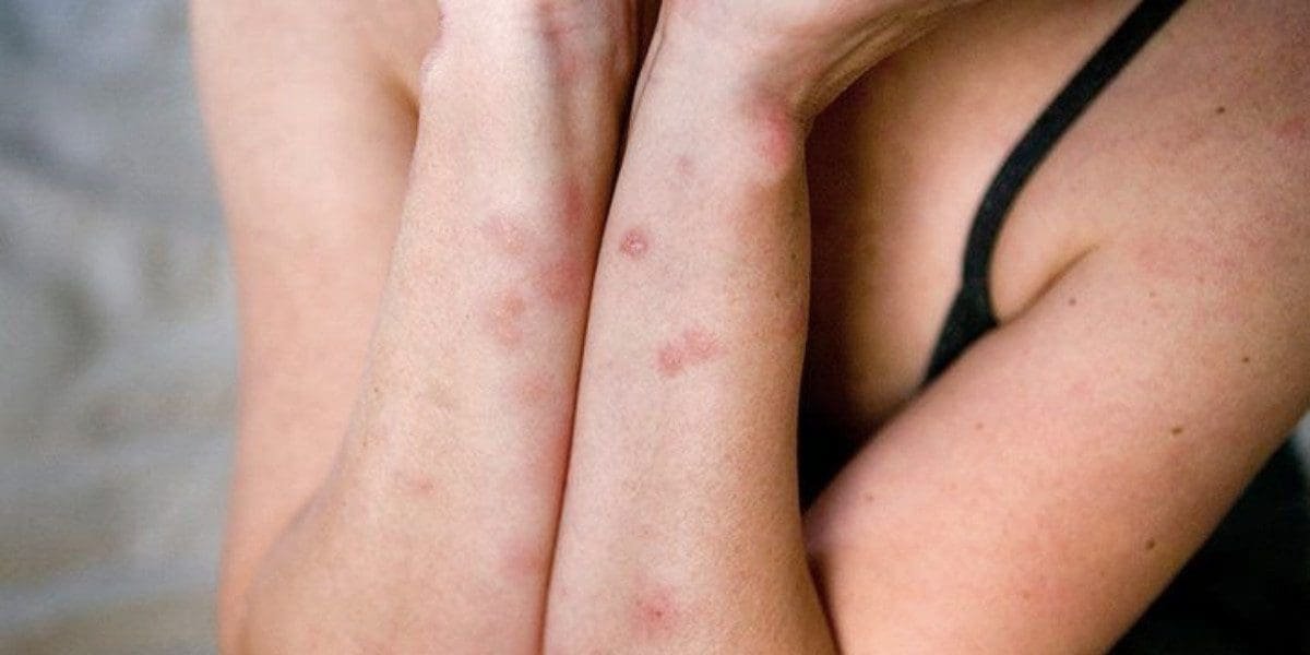Signs of bed bugs include clusters of red itchy bumps that appear during the night