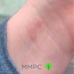 bed bug bites on wrist