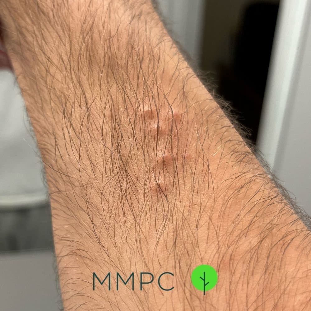 Bed Bug Bites Wrist Bedbugs Have Favorite Colors, Too, Study Finds