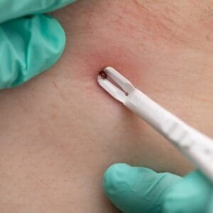 How to Remove a Tick?
